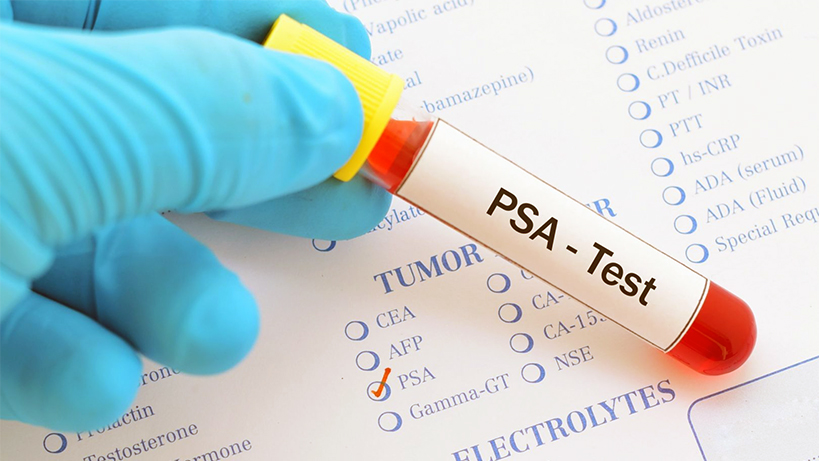 prostat-kanseri-tedavisi-icin-farkli-gorus